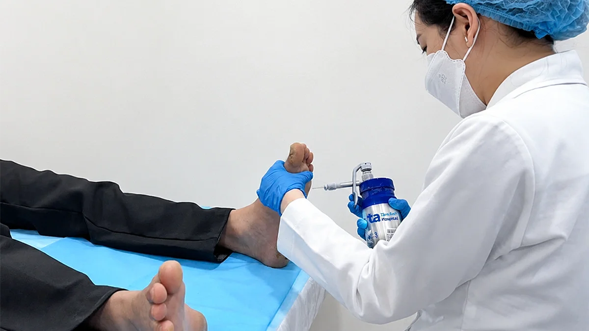 Khả năng điều trị dứt điểm các vết chai sần ở bàn chân